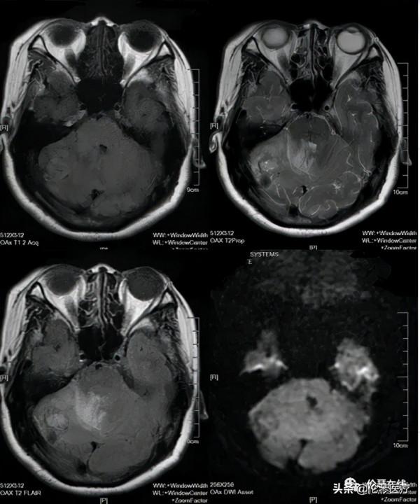 倫琴讀片會預告｜10月28日週四16:00陳向榮教授腦部影像病例讀片