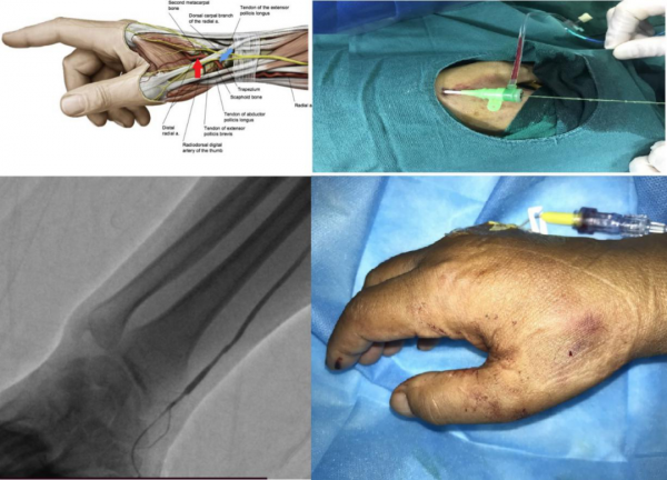 北京友誼醫院心血管中心成功開展經遠端橈動脈行急診冠脈介入手術 北京友誼醫院心血管中心成功開展經遠端橈動脈行急診冠脈介入手術