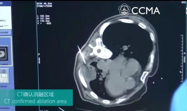 不抽菸居然也查出了肺小結節?專家這麼說 不抽菸居然也查出了肺小結節?專家這麼說
