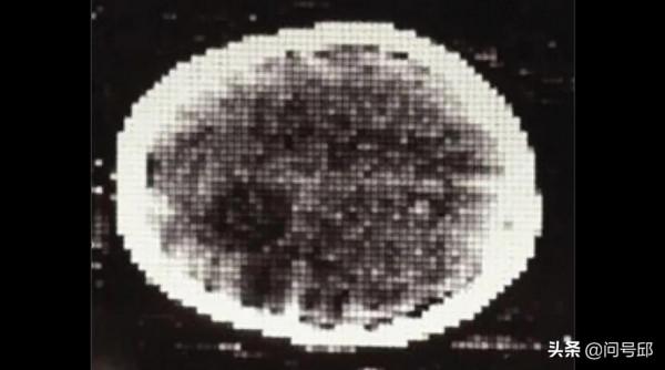 第一臺CT掃描器的誕生,標誌著醫學技術的革新具有里程碑意義 第一臺CT掃描器的誕生,標誌著醫學技術的革新具有里程碑意義