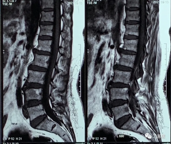 查體的重要性，一直按照腰椎間盤突出症治療的脊髓型頸椎病