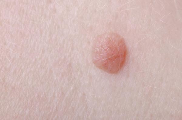 身上出現很多小紅點，不痛不癢是怎麼回事？這些病別心存僥倖