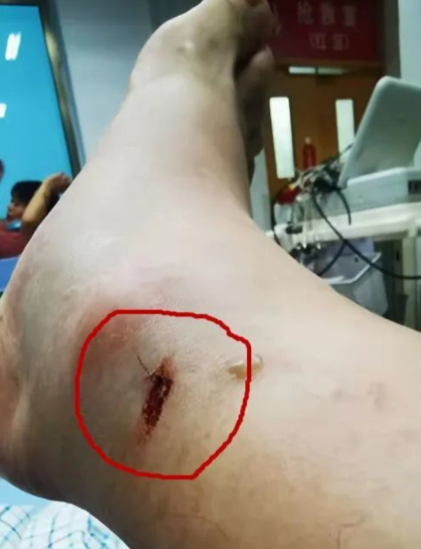 老人被五步蛇咬傷進醫院,男子被烙鐵頭咬,竟自救成功,咋自救? 老人被五步蛇咬傷進醫院,男子被烙鐵頭咬,竟自救成功,咋自救?