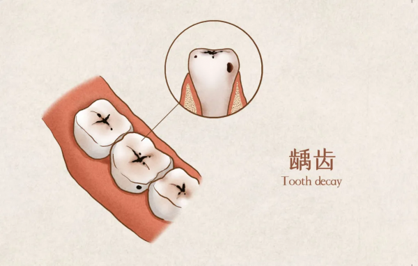 刷牙前要不要蘸水?衝牙器有用嗎?一文get這些護牙小知識 刷牙前要不要蘸水?衝牙器有用嗎?一文get這些護牙小知識