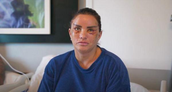 英43歲女星第五次整容被拍,頭部纏著層層繃帶,眼周瘀傷兩頰浮腫 英43歲女星第五次整容被拍,頭部纏著層層繃帶,眼周瘀傷兩頰浮腫