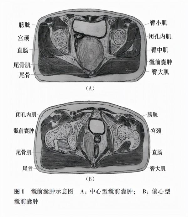 填補空白 | 骶前囊腫規範化診療有了新標準,這位專家推出了中國專家共識 填補空白 | 骶前囊腫規範化診療有了新標準,這位專家推出了中國專家共識