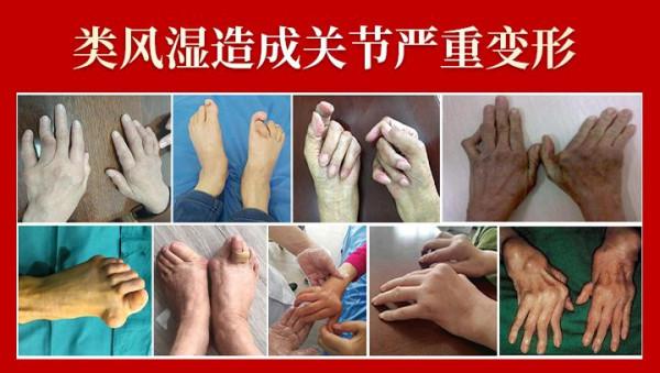 類風溼患者平均壽命有多長？原來類風溼真的會影響壽命