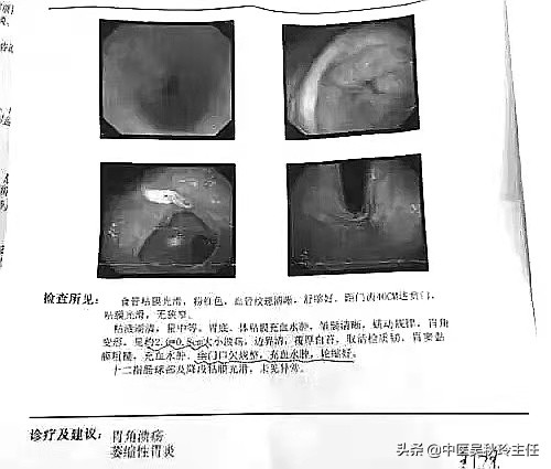 趙老師喝中藥後，潰瘍好了，胃炎痊癒了，一位胃炎患者的看診歷程