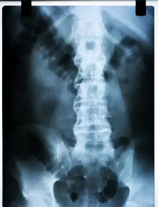 脊柱關節炎、強直性脊柱炎怎麼能分清?一文教你讀懂 脊柱關節炎、強直性脊柱炎怎麼能分清?一文教你讀懂