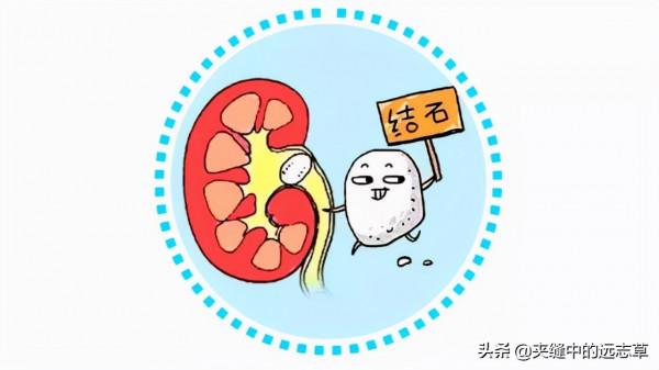 結石？送你九味中藥，清溼熱，化堅石，止澀痛，不來了解一下嗎？