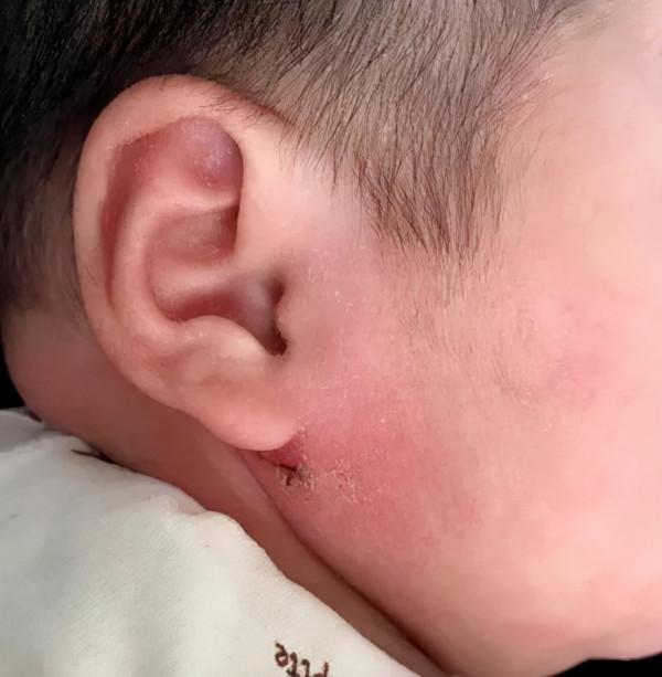 嬰兒溼疹與保溼 嬰兒溼疹與保溼