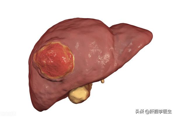 肝癌從3釐米長到6釐米需要多久? 肝癌從3釐米長到6釐米需要多久?