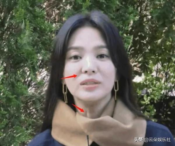 宋慧喬近照面部下垂嚴重，眼部遮擋不住的疲態，狀態不佳很憔悴