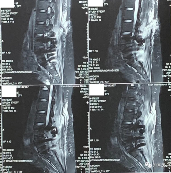 27歲女性，兩間隙腰椎間盤突出症，6顆釘子，4個融合器