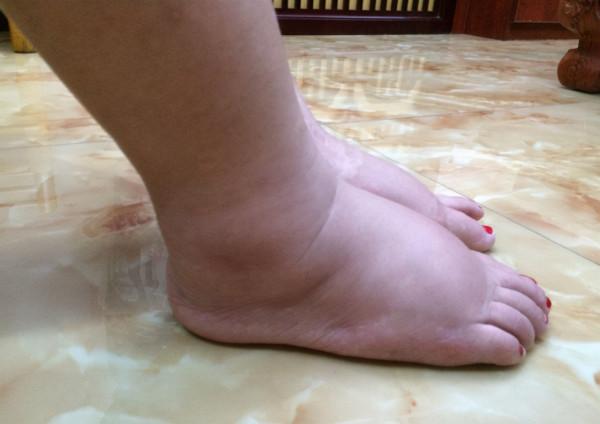 女性想知道自己是否健康，低頭看看腳就知道，如有4個現象要留心