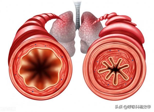 得了支氣管擴張，感覺生命沒有意義了，如何緩解？