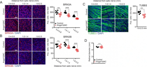 扭轉先天性青光眼解剖學缺陷 降眼壓效果持久 開闢青光眼治療新賽道