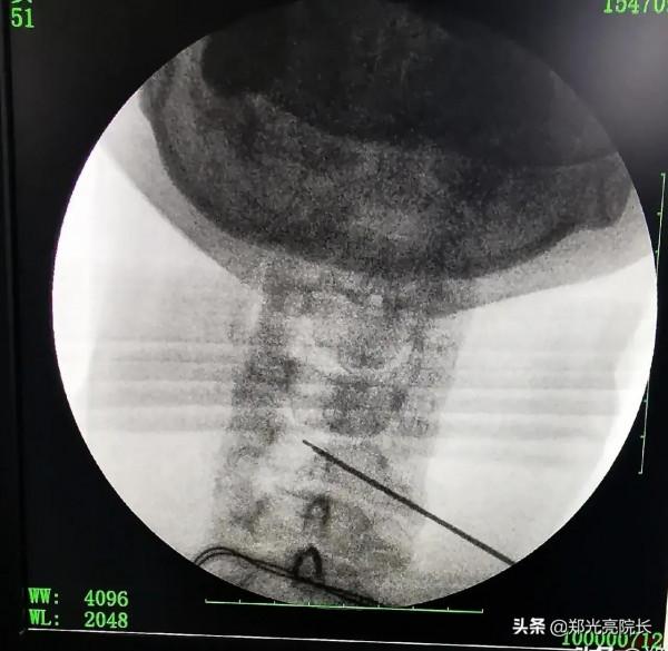 頸椎病保健“三步曲”