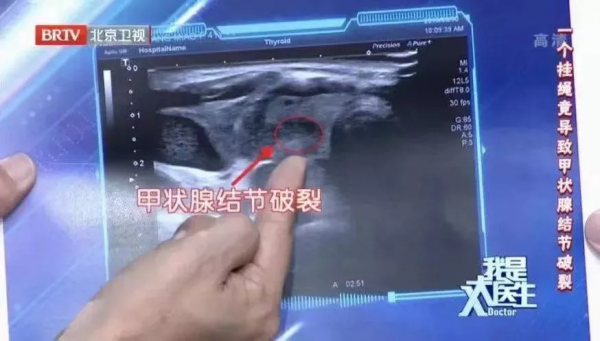 2年沒複查,息肉變成癌!B超報告裡出現“這些字眼”可能危險了 2年沒複查,息肉變成癌!B超報告裡出現“這些字眼”可能危險了
