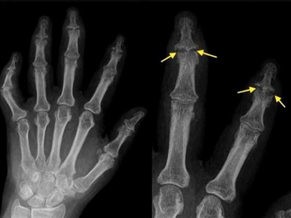 五十多歲的女性們，您有晨起手指僵硬、疼痛，甚至變形的現象嗎？