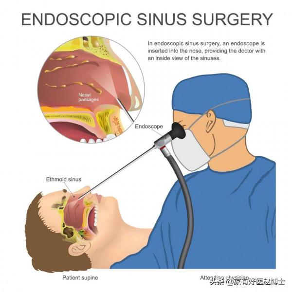 最常見5類息肉每個人都可能有，哪些無癌變風險，哪些需要切除？