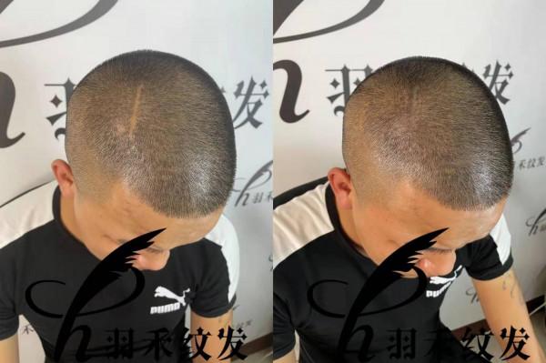 頭部傷疤有辦法修復嗎？