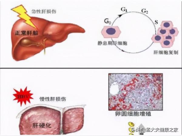 吃他汀的朋友注意出現3種情況，必須馬上停藥，需引起重視