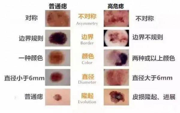 不是所有“黑痣”都善良！醫生：識別高危痣，謹記ABCDE原則