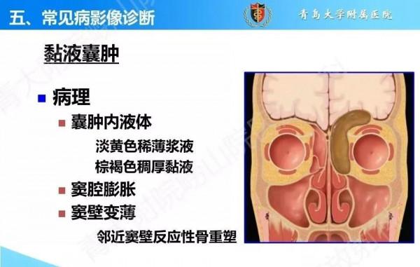 頭頸五官CT斷層解剖圖及常見病影像診斷