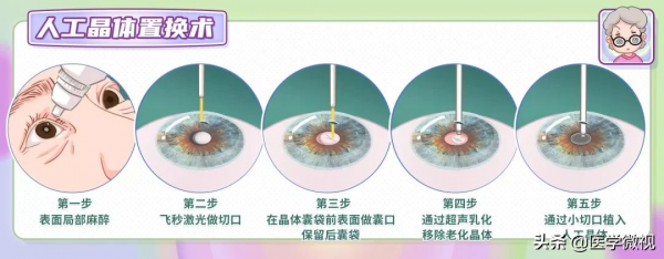 老花眼是遠視嗎？除了戴老花鏡，還有其他矯正方法嗎？