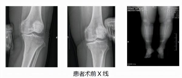 人工智慧+新型單髁關節 “黑科技”搭配“新材料”助哈醫大一院骨科專家一天治癒五年老腿疼 人工智慧+新型單髁關節 “黑科技”搭配“新材料”助哈醫大一院骨科專家一天治癒五年老腿疼