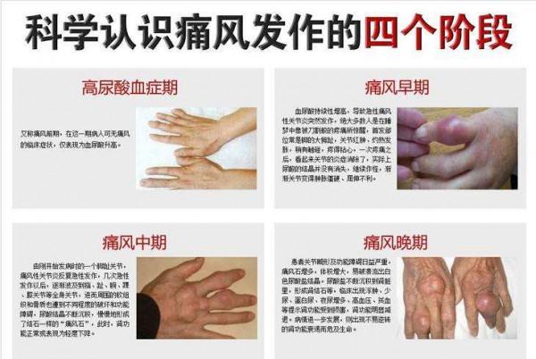 躺著就能治療痛風是真的嗎？免疫吸附技術&mdash;&mdash;快速治療痛風
