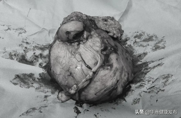 35年,8場手術,“圍觀”張大爺的縱橫人生 35年,8場手術,“圍觀”張大爺的縱橫人生