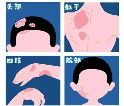 股癬是牛皮癬？這兩者有什麼不同？