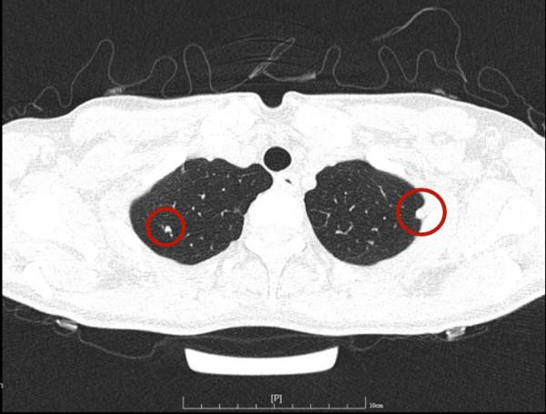 問診分析：兩肺多發實性結節，各科各醫院意見不一，如何是好？