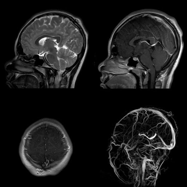 頭皮和顱骨病變的影像學特點 頭皮和顱骨病變的影像學特點