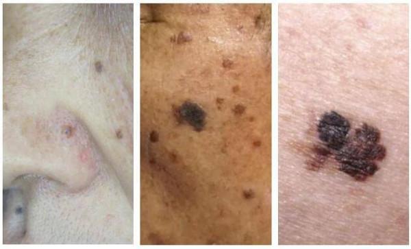 不是所有“黑痣”都善良！醫生：識別高危痣，謹記ABCDE原則