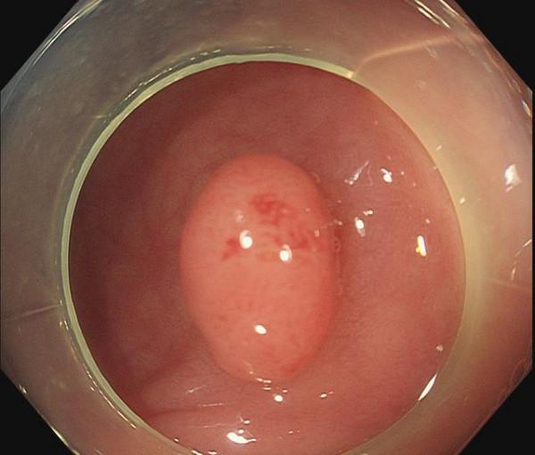 什麼是腸息肉?腸子里長息肉後,身體會有什麼感覺?早知道早受益 什麼是腸息肉?腸子里長息肉後,身體會有什麼感覺?早知道早受益