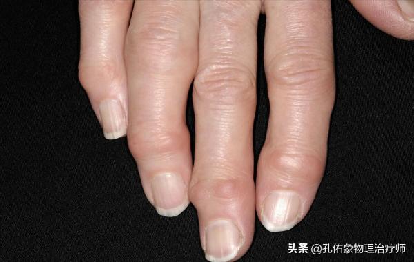 50歲左右的中老年人，手指僵硬、疼痛、怕冷、變形，預示哪些疾病
