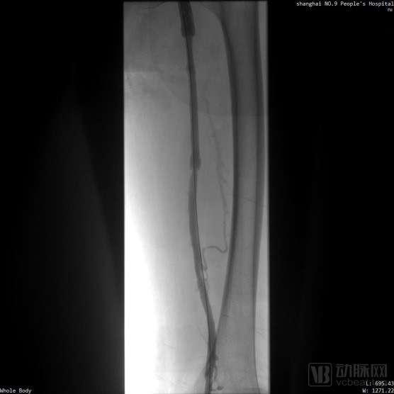 血栓清除率超90％，取出亞急性血栓，樂奧醫療靜脈取栓導管新突破