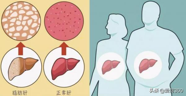 身體若有脂肪肝，一定會有這些表現，得了脂肪肝如何飲食？