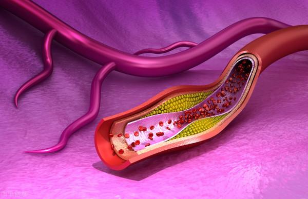 高脂血症患者怎樣選擇合適的降脂藥物？目前的最強降脂藥物是誰？