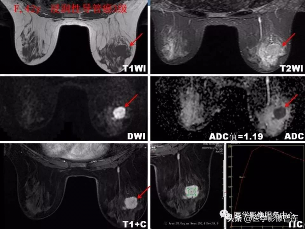 乳腺T2WI高訊號腫瘤病變的診斷思路 乳腺T2WI高訊號腫瘤病變的診斷思路
