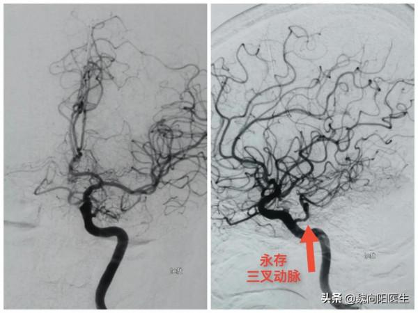 奔著做支架來醫院，最後發現是血管變異引起，避免了一場大手術