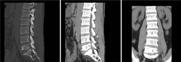 腰疼來就診，在放射科我們需要做哪些檢查？