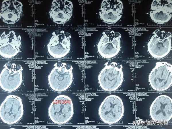 頭暈不檢查 後果真可怕