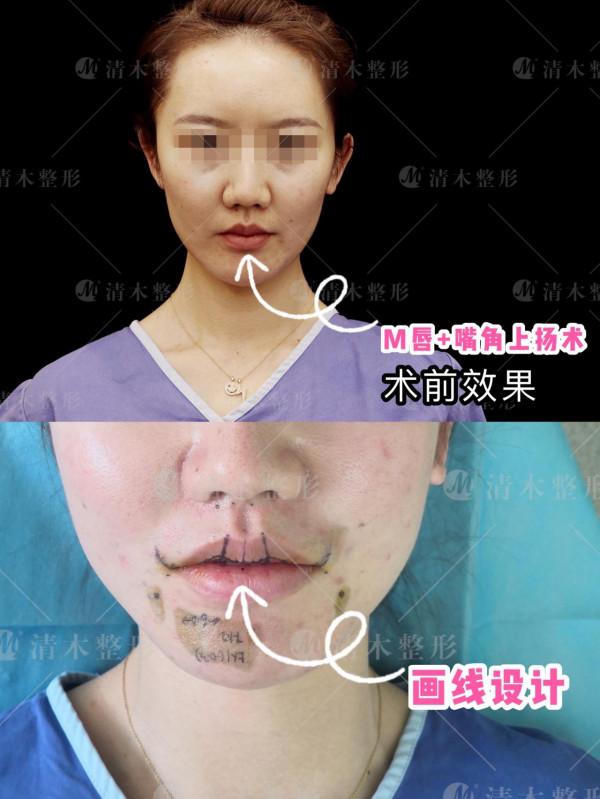 上唇m型+嘴角上揚 上唇m型+嘴角上揚