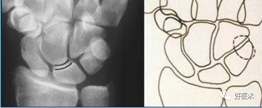 贊！腕關節X線高畫質解剖+腕骨脫位典型病例