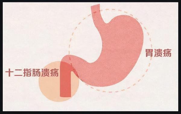 胃潰瘍和十二指腸潰瘍如何辨別？幽門螺桿菌是不是唯一病因？
