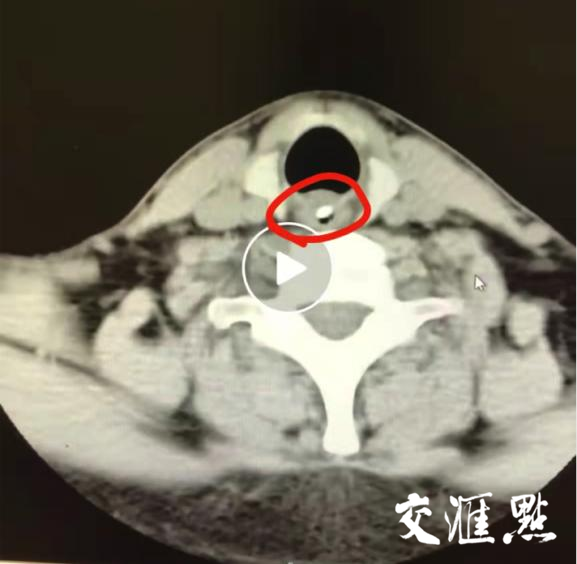 91歲老人年夜飯雞骨卡喉，專家團隊成功取出化險為夷